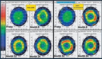 LASIK XTRA: RISULTATI PIU’ STABILI GRAZIE AL CROSS-LINKING ACCELERATO